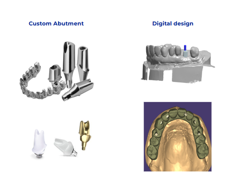 Custom titanium and zirconia implant abutments alongside digital implant planning models showing emergence profile, screw access and soft-tissue management options
