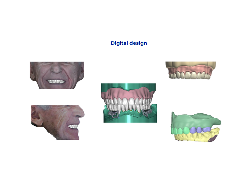 Digital smile design integrating facial photos with maxillary and mandibular 3D datasets to visualize tooth position, occlusion and implant-supported prostheses