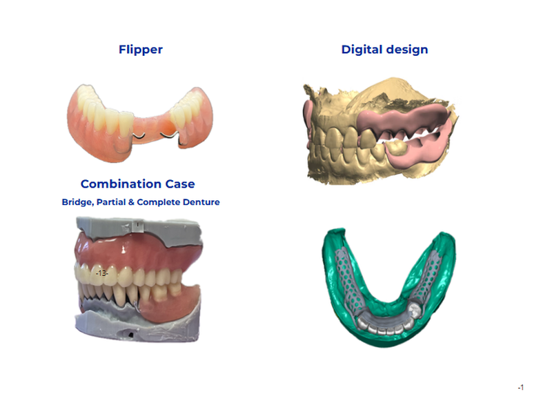 Flipper provisional denture, complex combination prosthodontic case and digitally designed mandibular framework illustrating transitional, definitive and CAD-planned treatments for patients