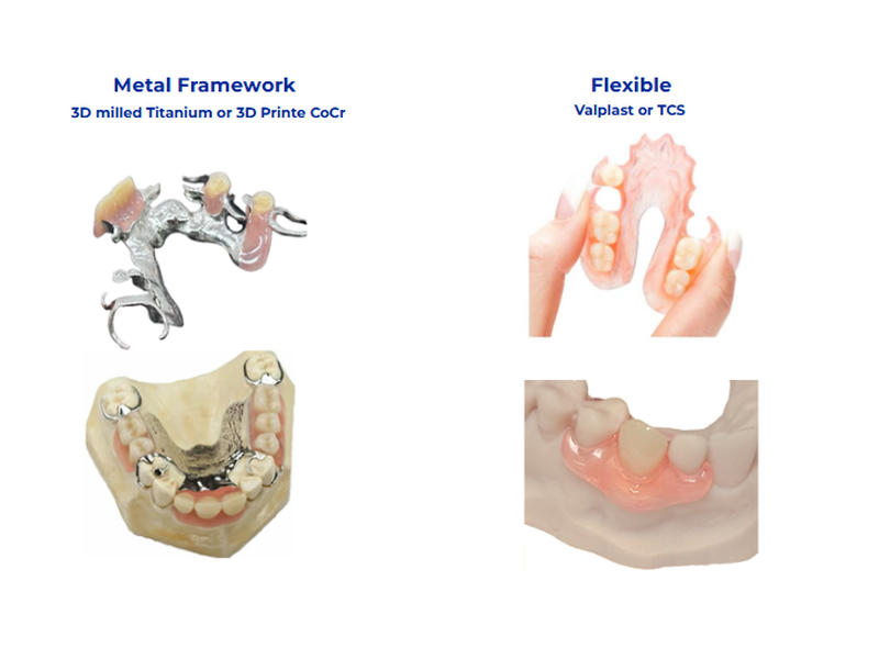 Metal framework partial dentures with milled or printed titanium or CoCr contrasted against flexible Valplast-style removable partial denture options available