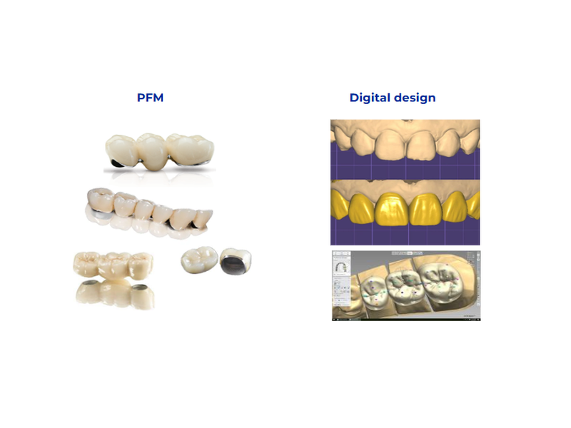Traditional porcelain-fused-to-metal bridges and crowns contrasted with digital CAD design screenshots illustrating virtual occlusion, contours and restorability assessment for planning