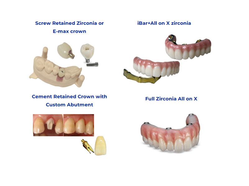 Overview of screw-retained crowns, cement-retained custom abutment restorations, zirconia All-on-X prostheses and titanium bar-supported hybrid implant bridges for edentulous patients
