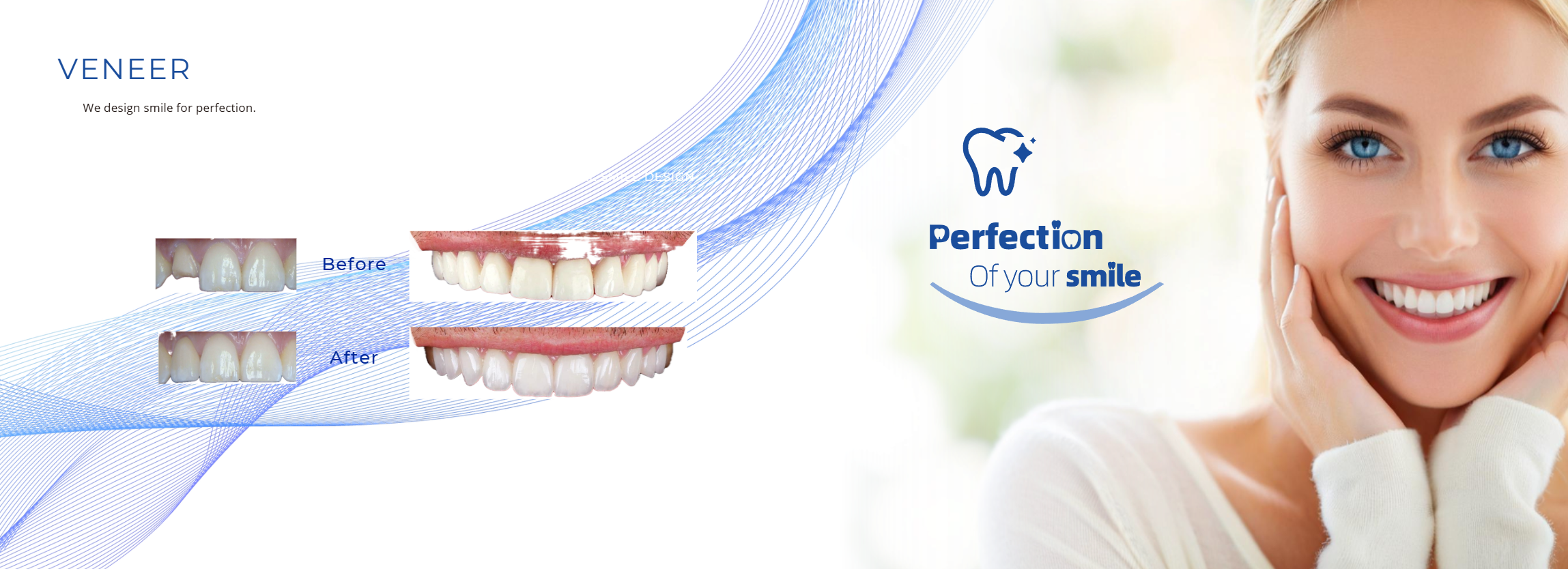 Veneer smile banner - We design smile for perfection